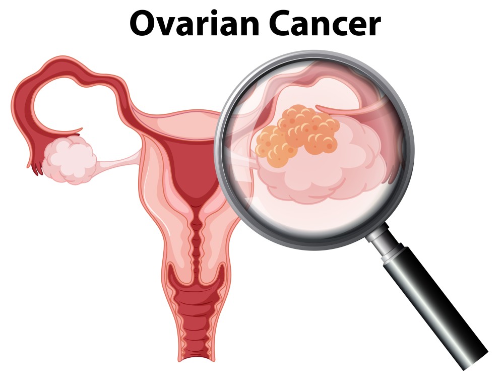 Ovarian Cancer